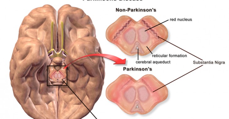 Przełomowy lek na Parkinsona i nowe technologie biomedyczne
